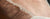 Hyperpigmentation